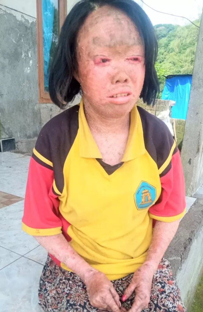 Puluhan Tahun Menanggung Derita Kulit Melepuh, Putu Malini Harapkan Bantuan Pengobatan